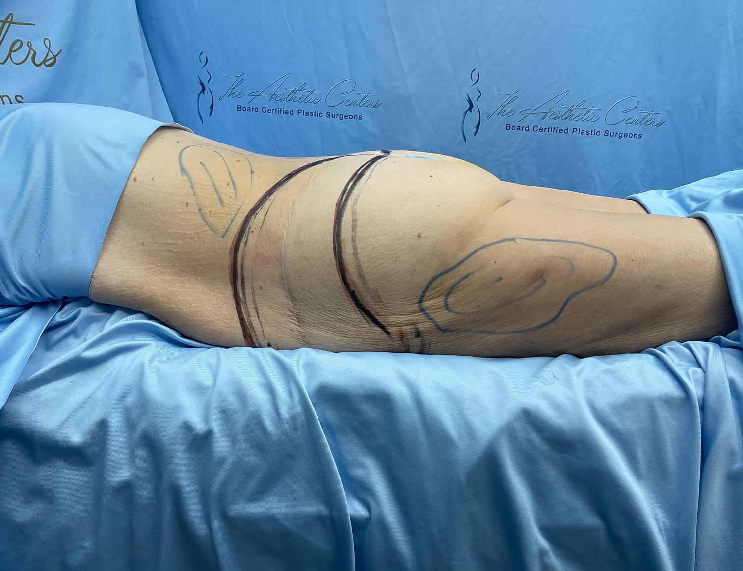 Body contouring markings on surgical table.