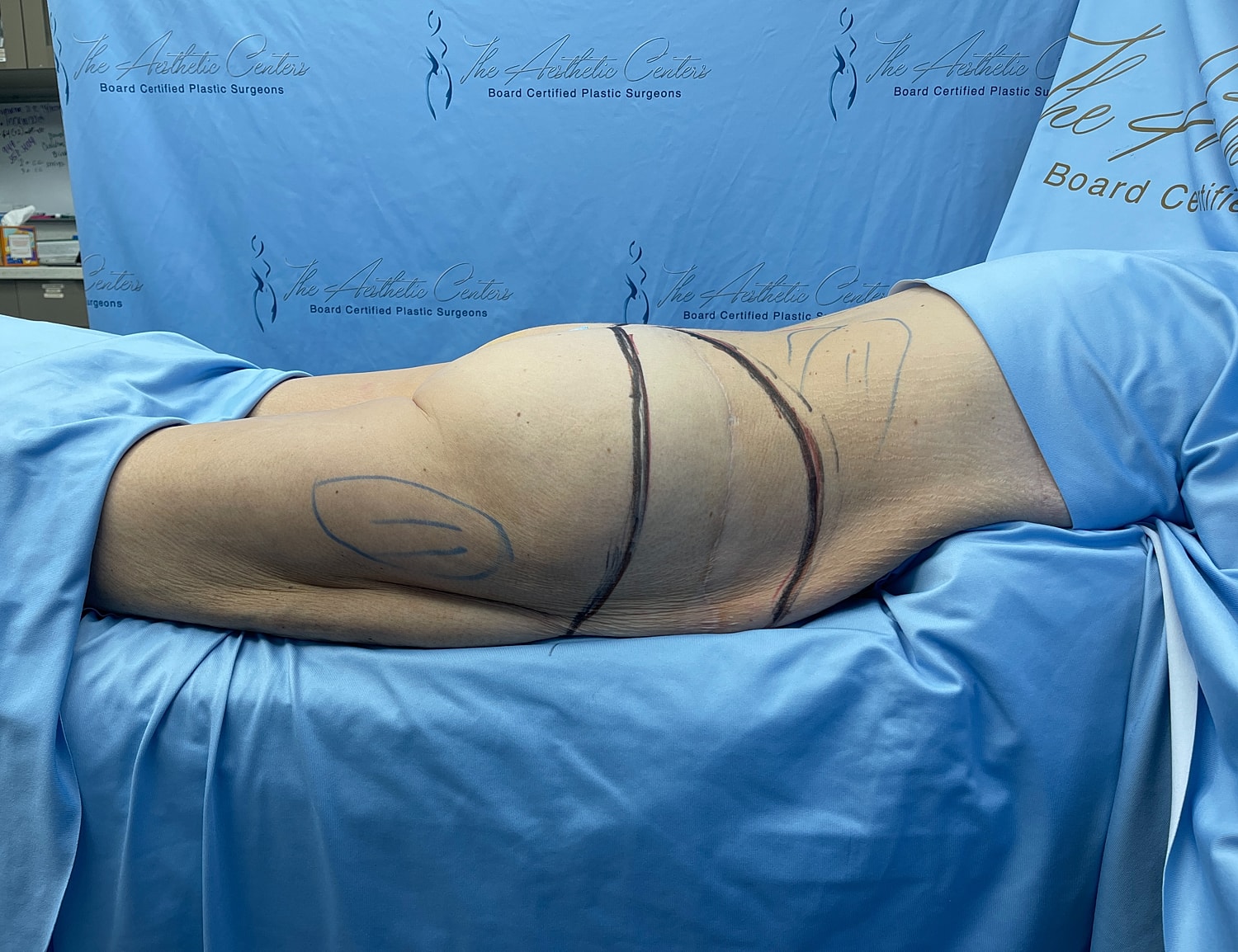 Body contouring procedure preparation phase.