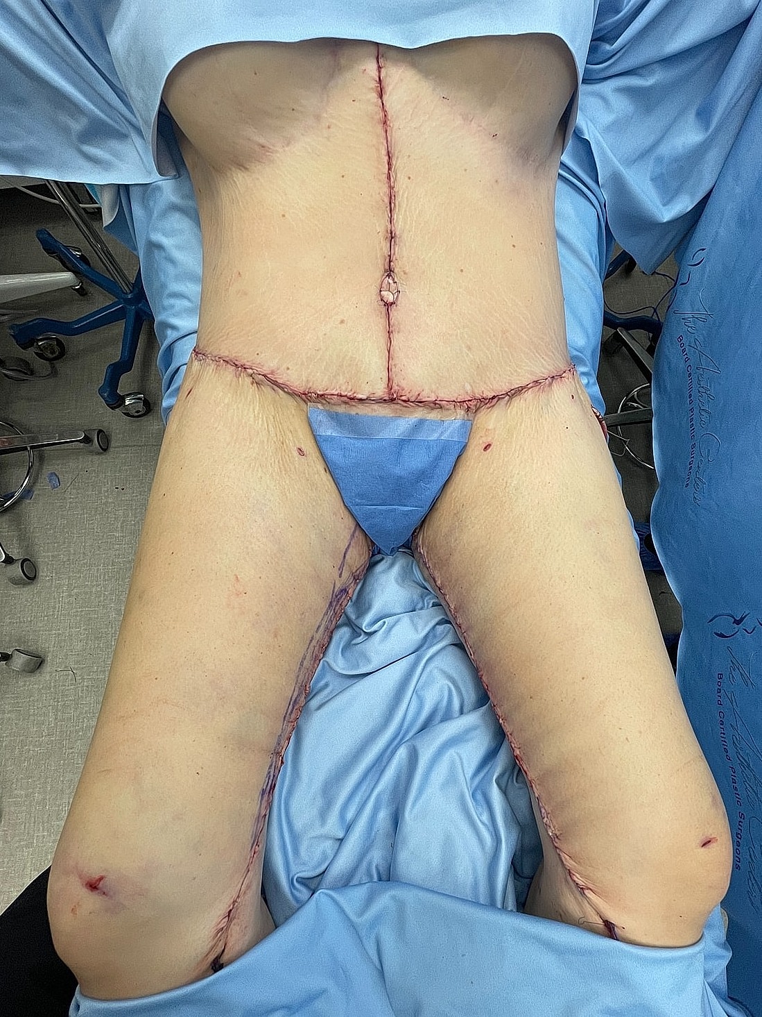 Post-surgical abdomen and thigh with sutures.