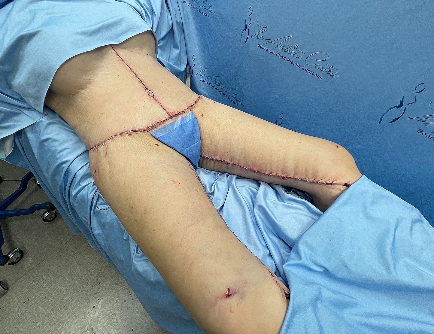 Post-surgery abdomen with sutures and draping.