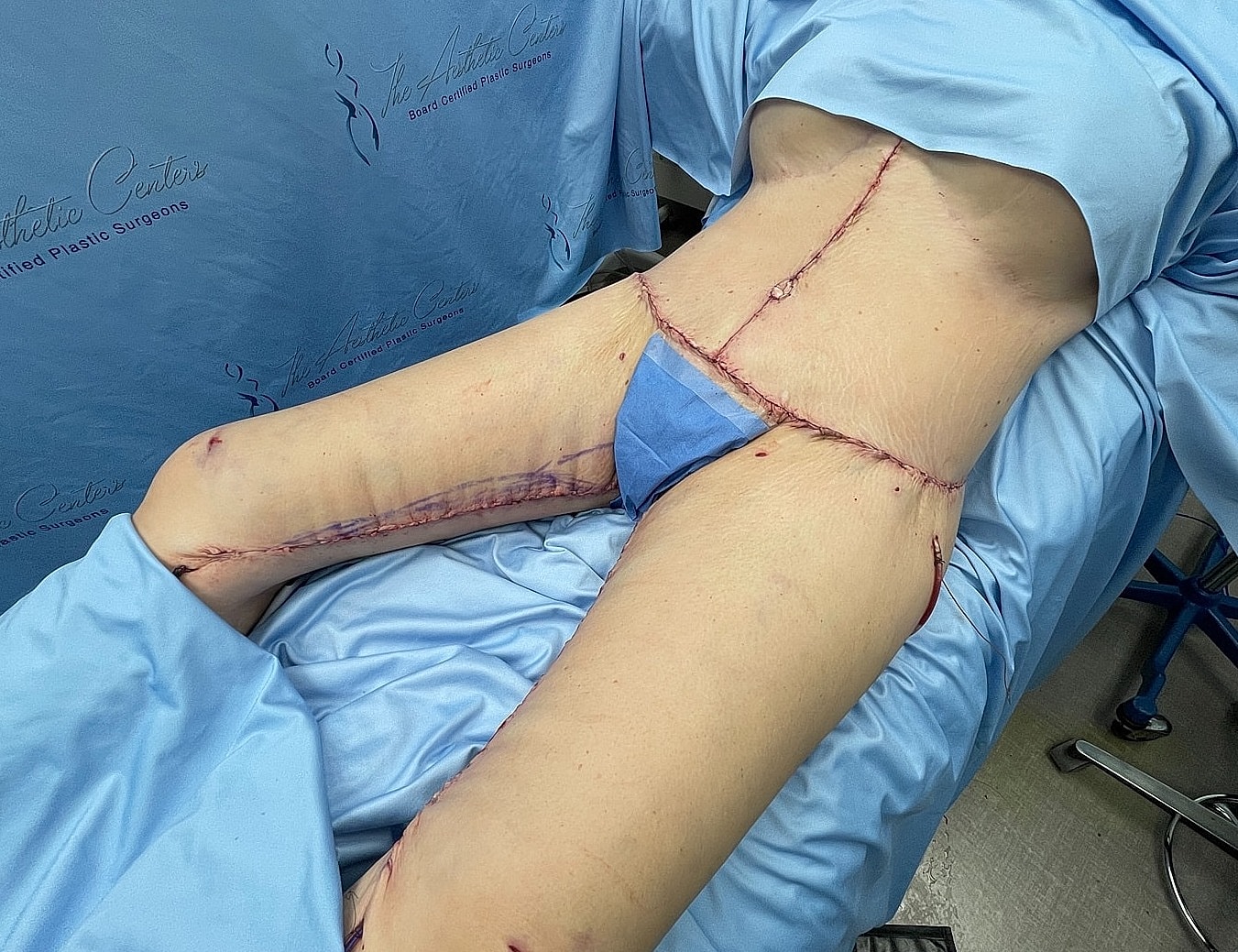 Post-operative view of surgical incisions and recovery.