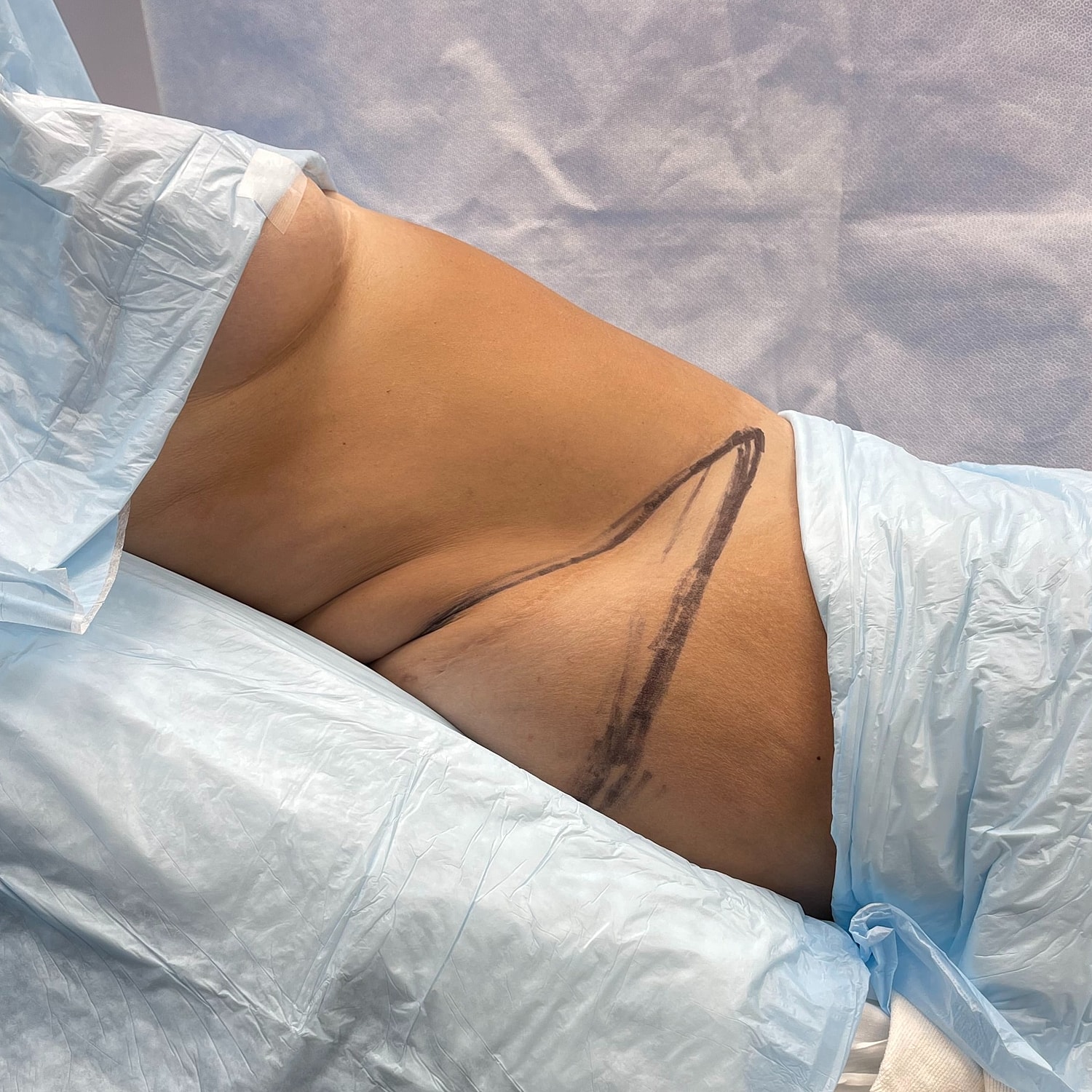Patient preparing for a surgical procedure.