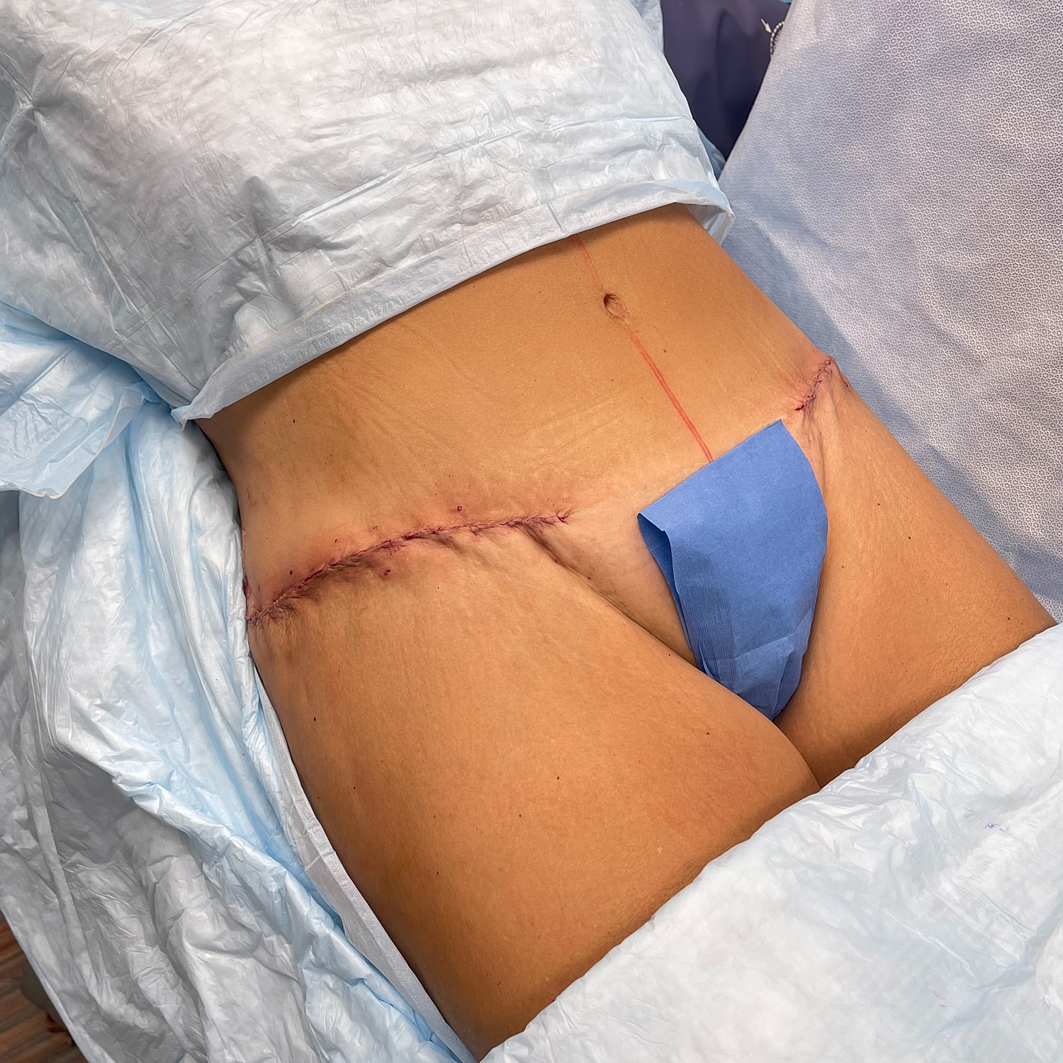 Surgical incision on abdomen post-operation.