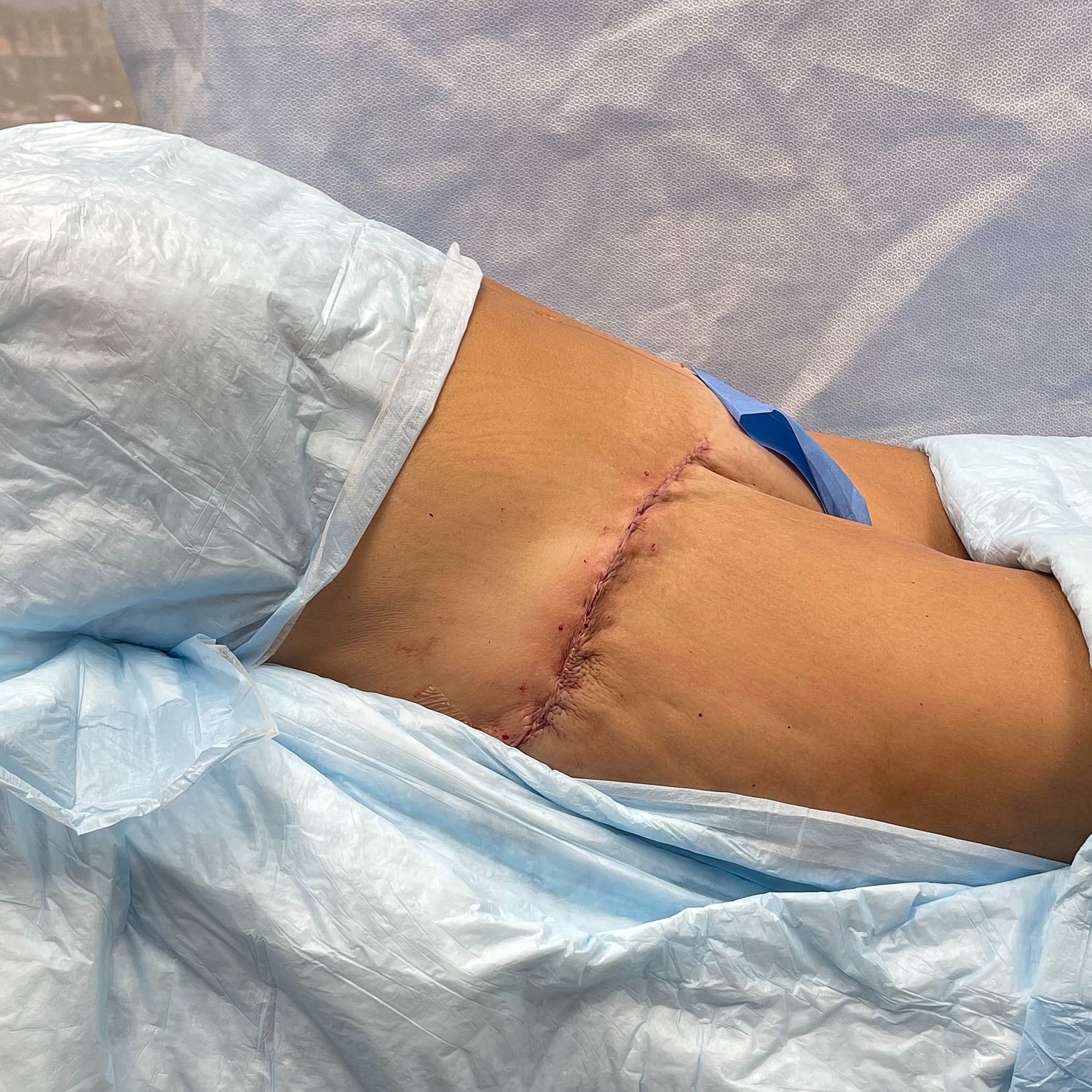 Surgical incision on patient’s lower back.