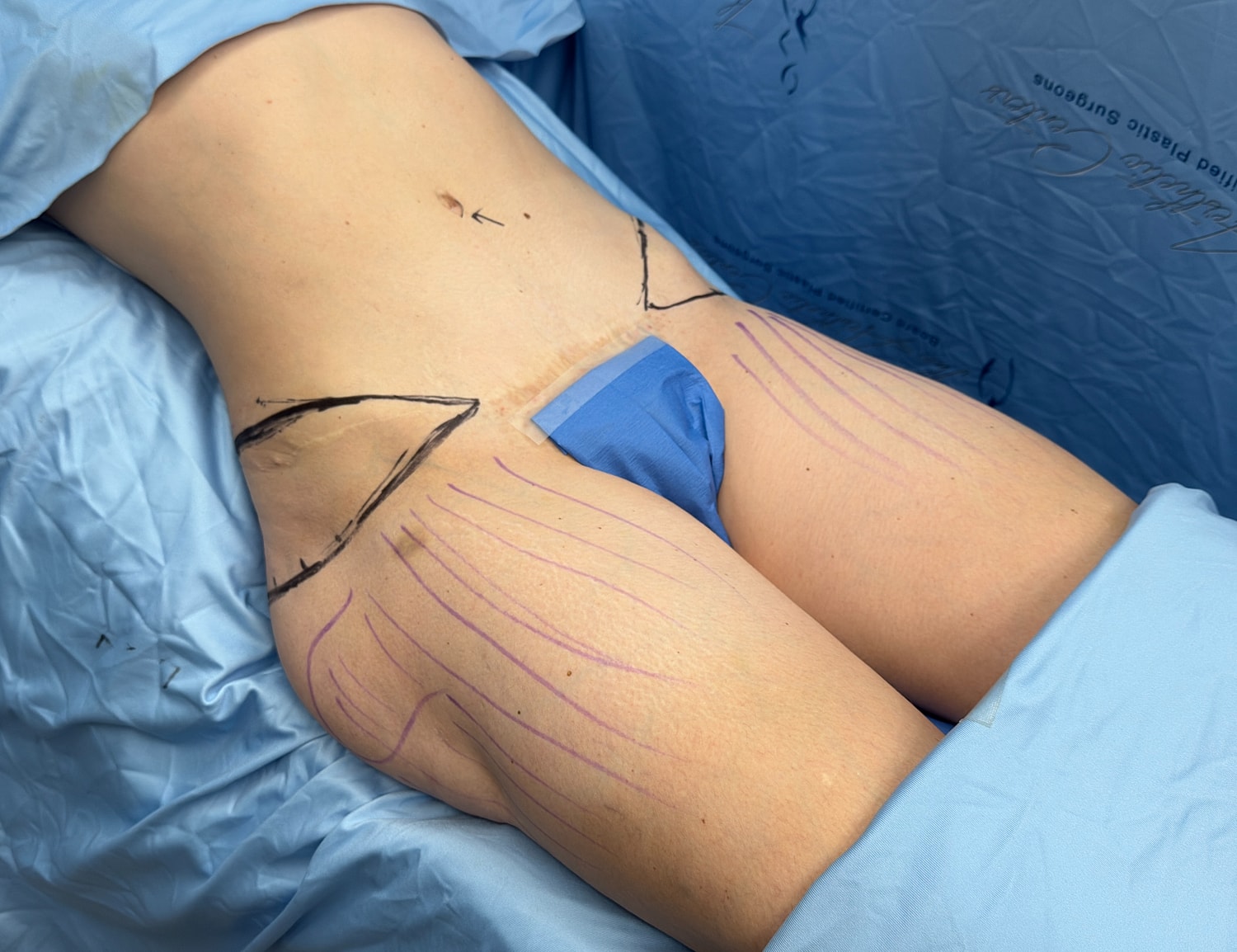 Patient preparation for surgical procedure.