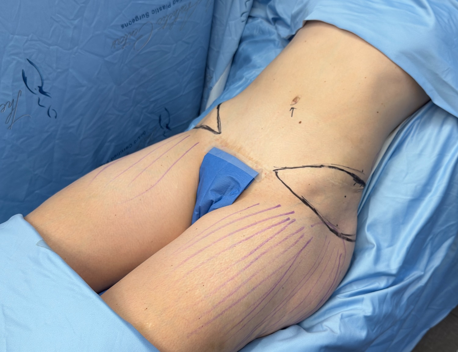 Patient preparation for cosmetic surgery procedure.