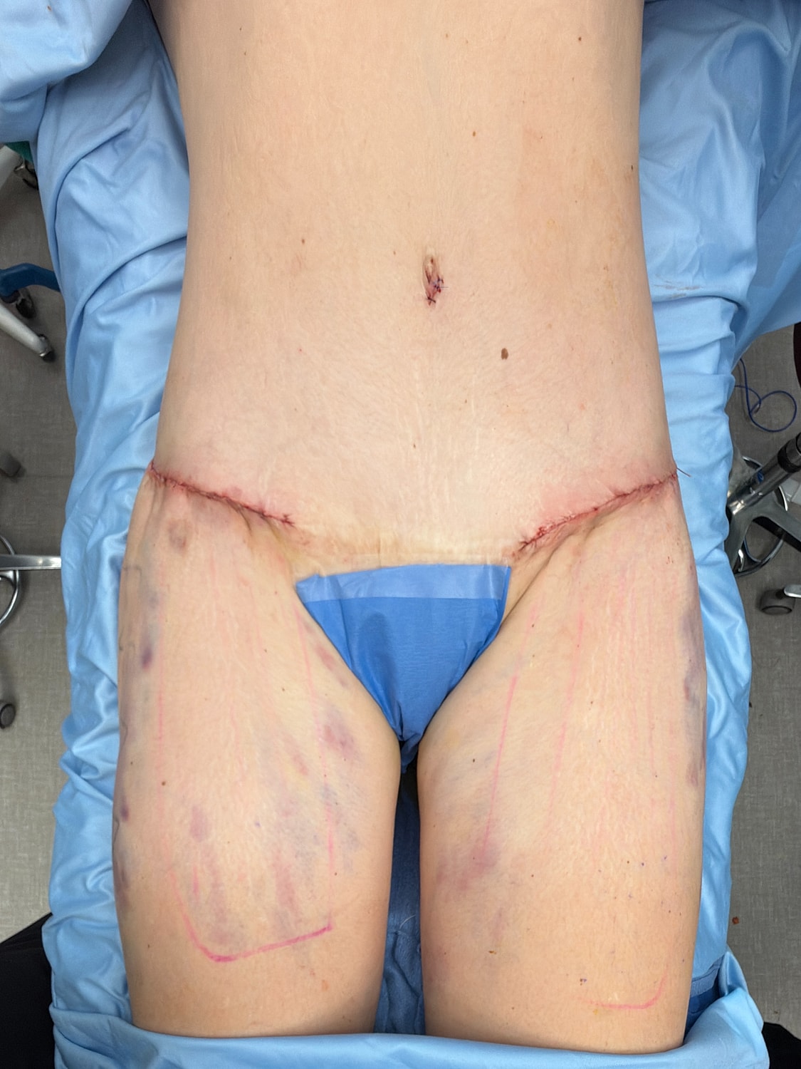 Post-operative abdominal image with sutures.