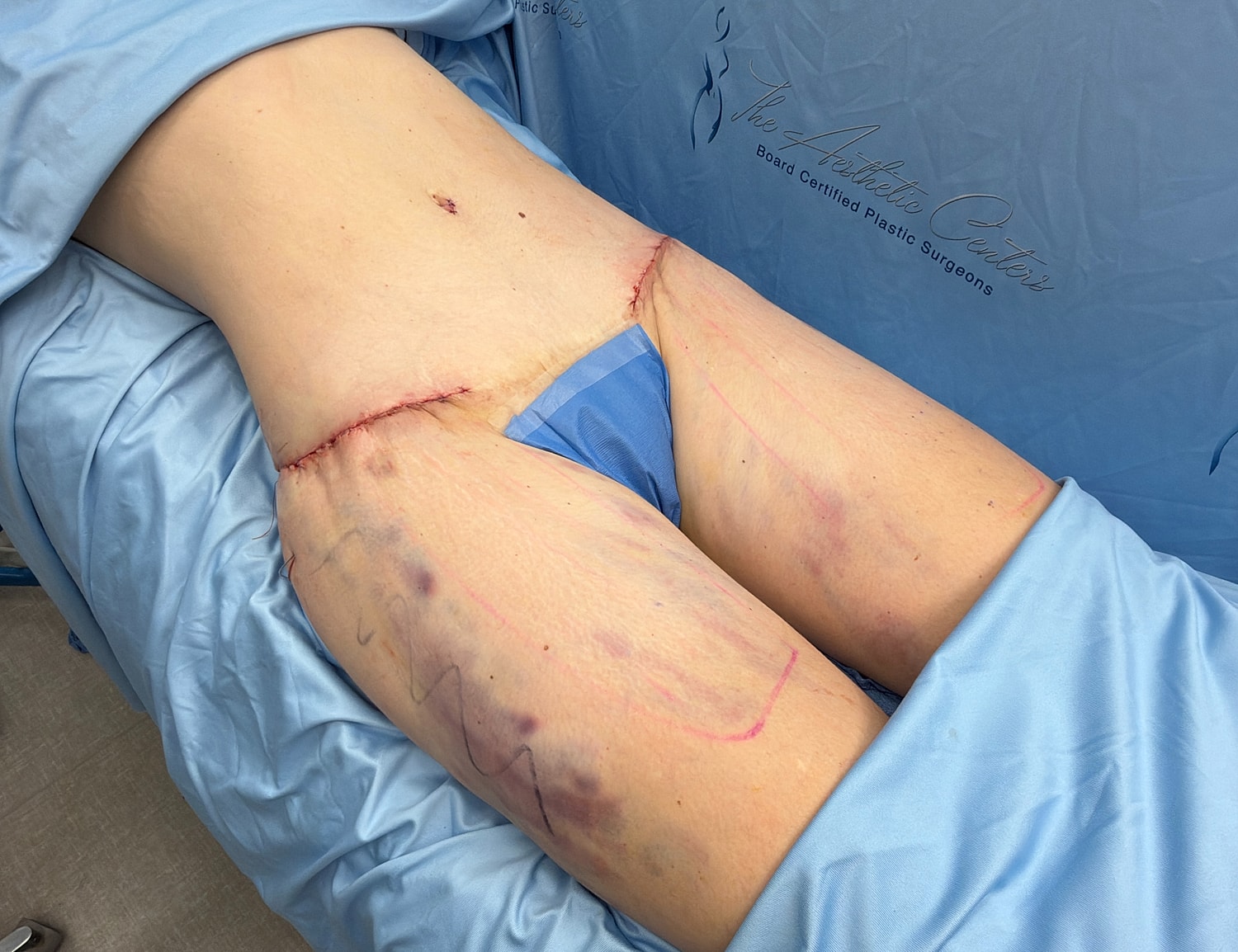 Post-surgery view of a patient's thighs.