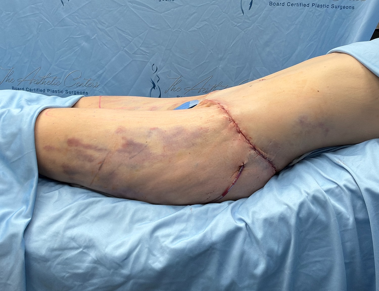 Surgical site with stitches on patient's leg.