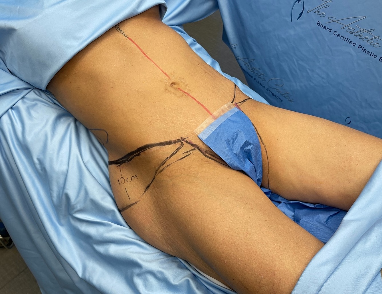 Surgical markings on body for procedure preparation.