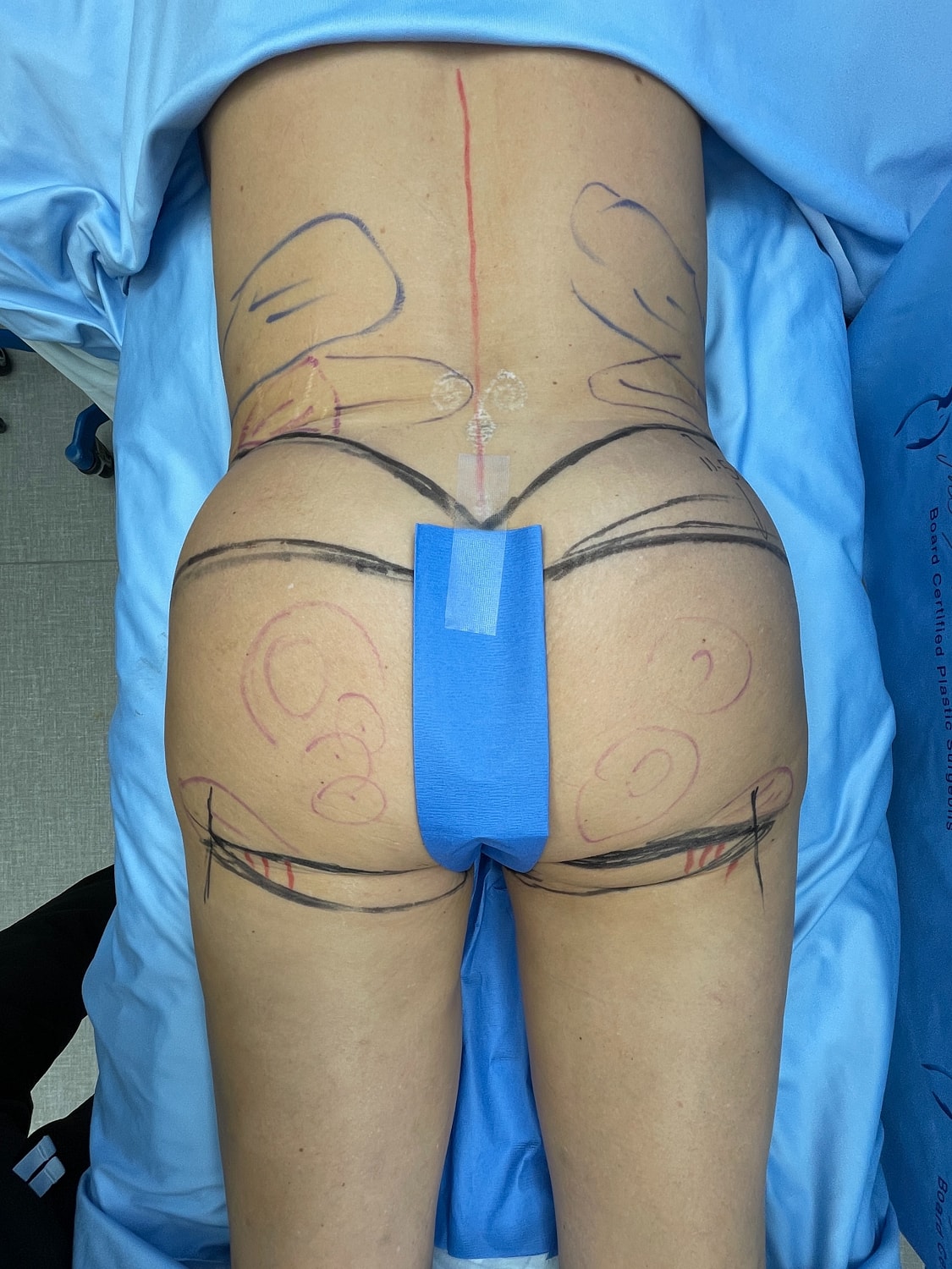 Body contouring preparation with markings on skin.