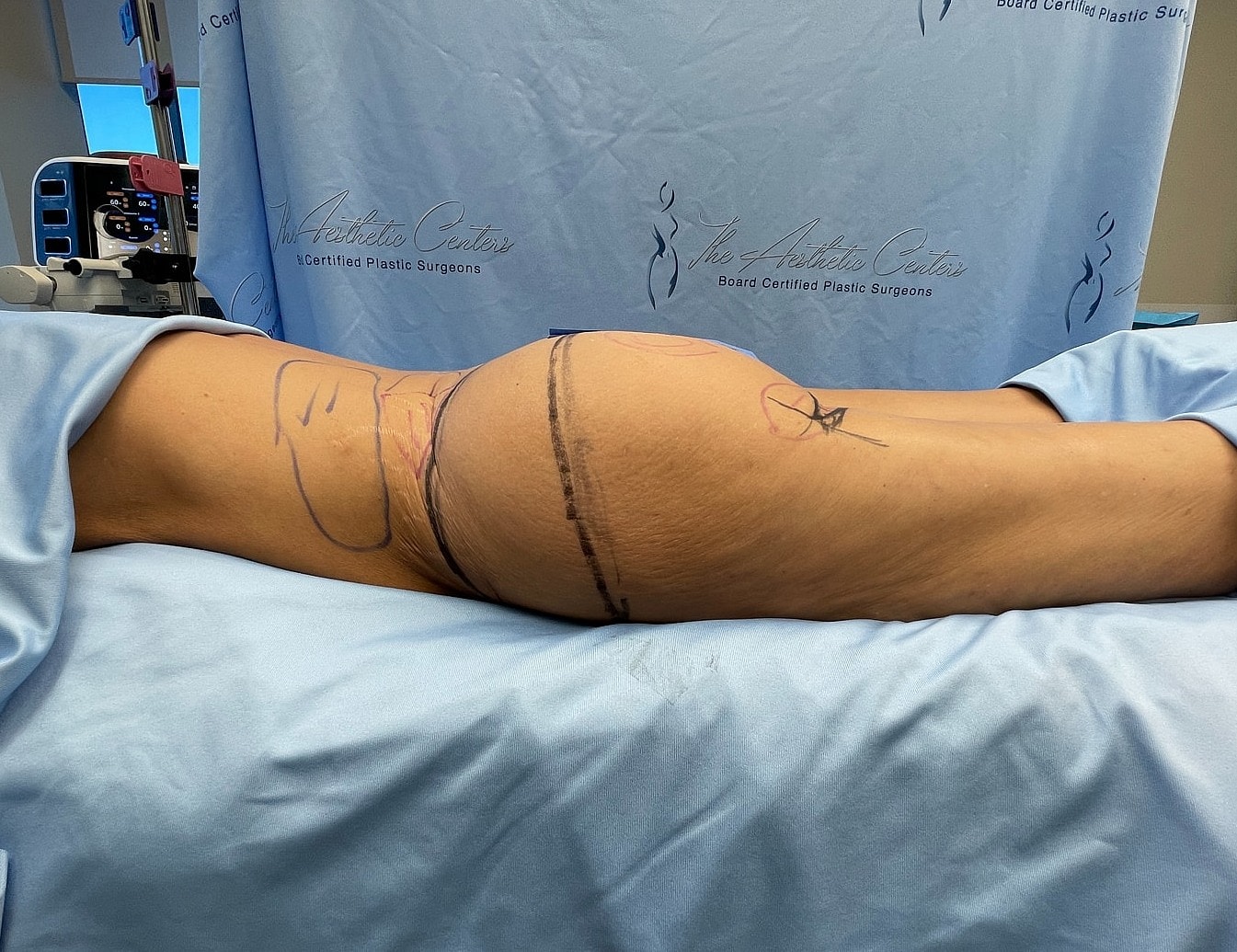 Patient preparation for plastic surgery procedure.