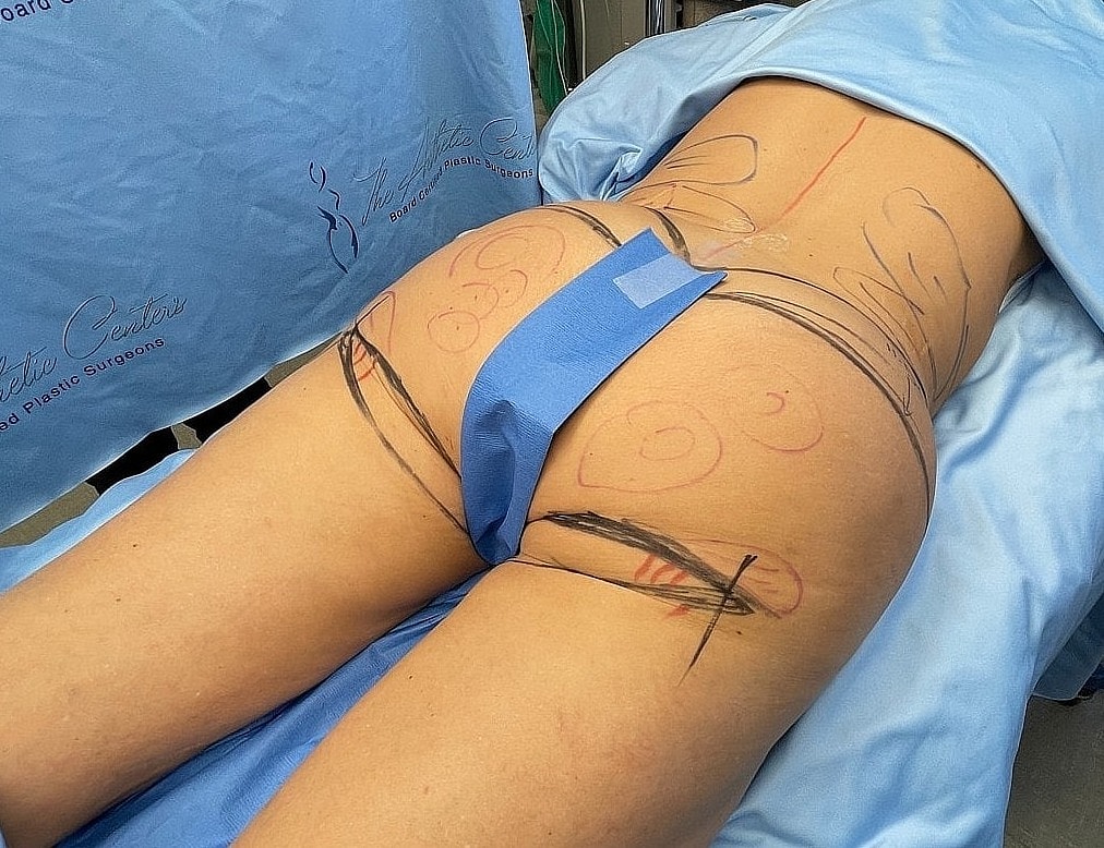 Patient preparation for cosmetic surgery procedure.