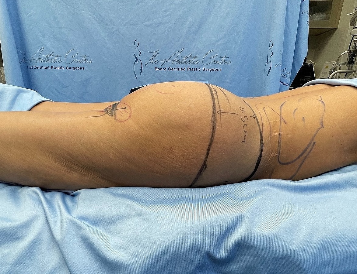 Patient prepped for cosmetic surgery procedure.