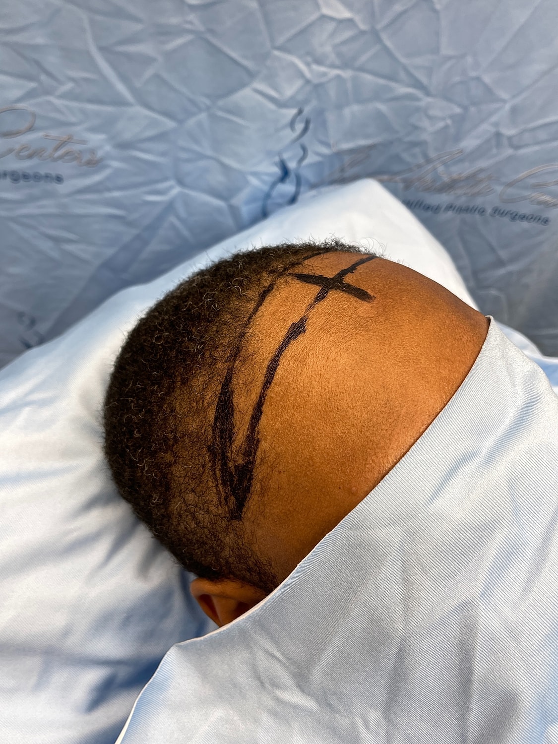 Marked scalp in preparation for procedure.