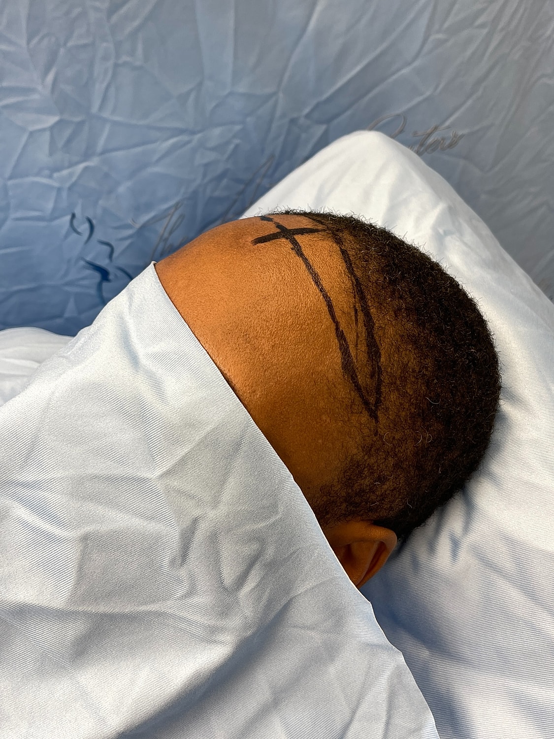 Patient preparing for medical procedure under drapes.
