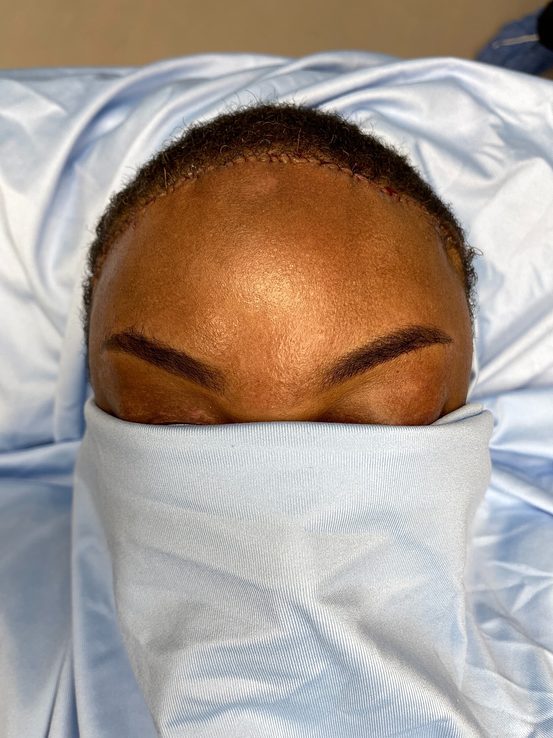 Post-surgery recovery, covered eyes and forehead.