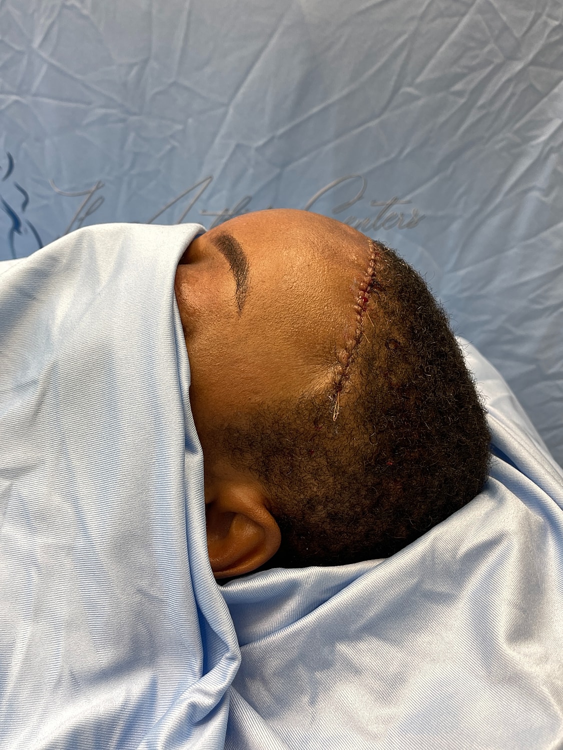 Patient recovering from surgical procedure with stitches.