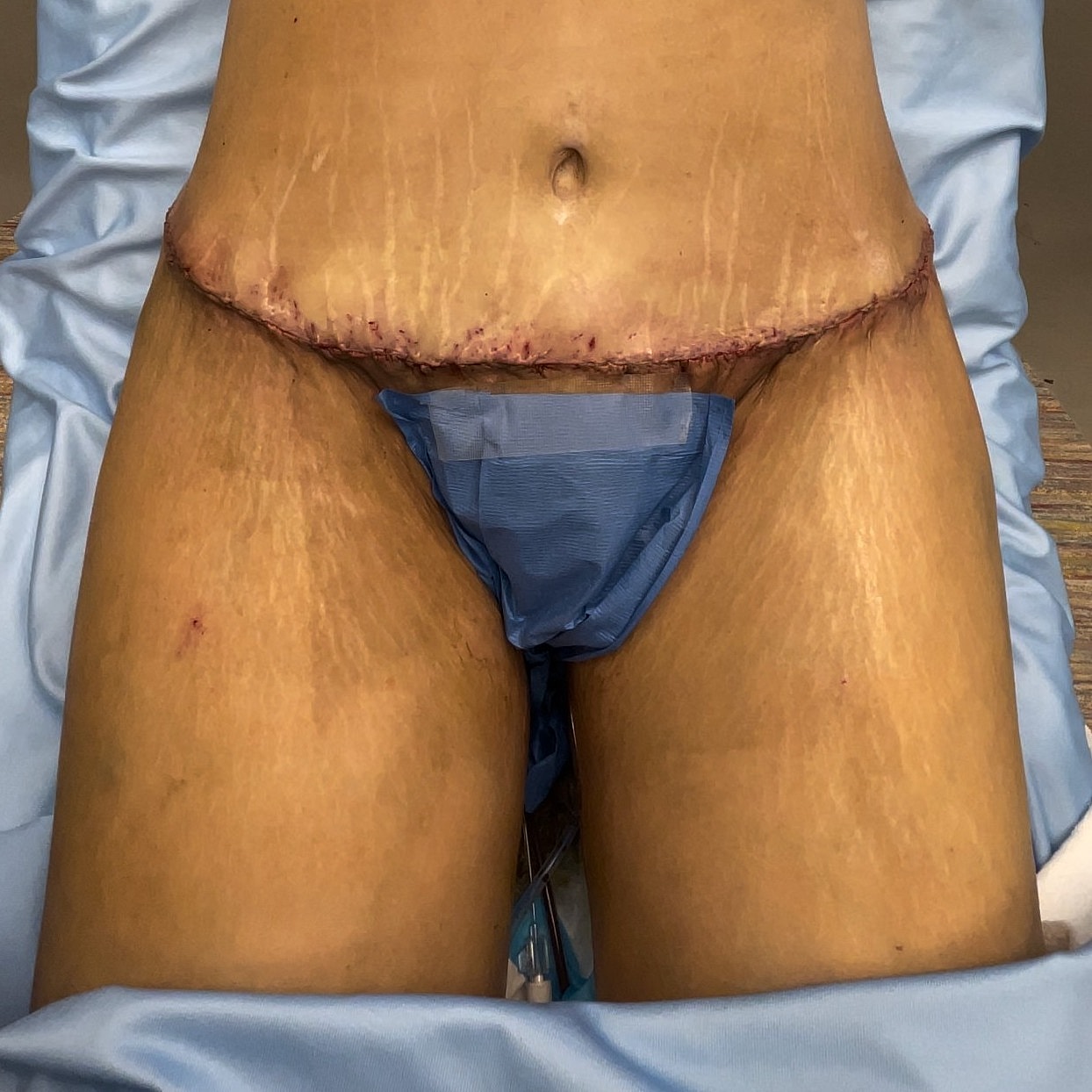 Medical model showing abdominal surgical incision.