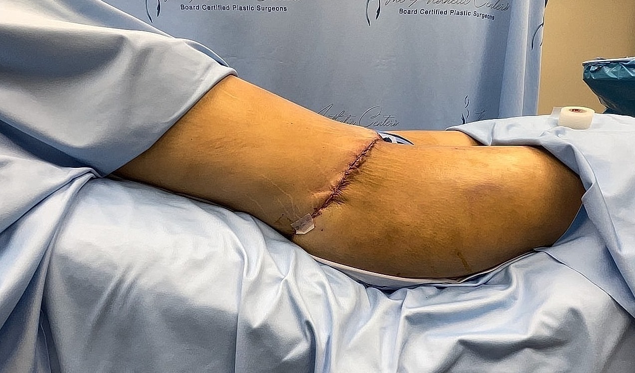 Patient's thigh with surgical incision post-procedure.
