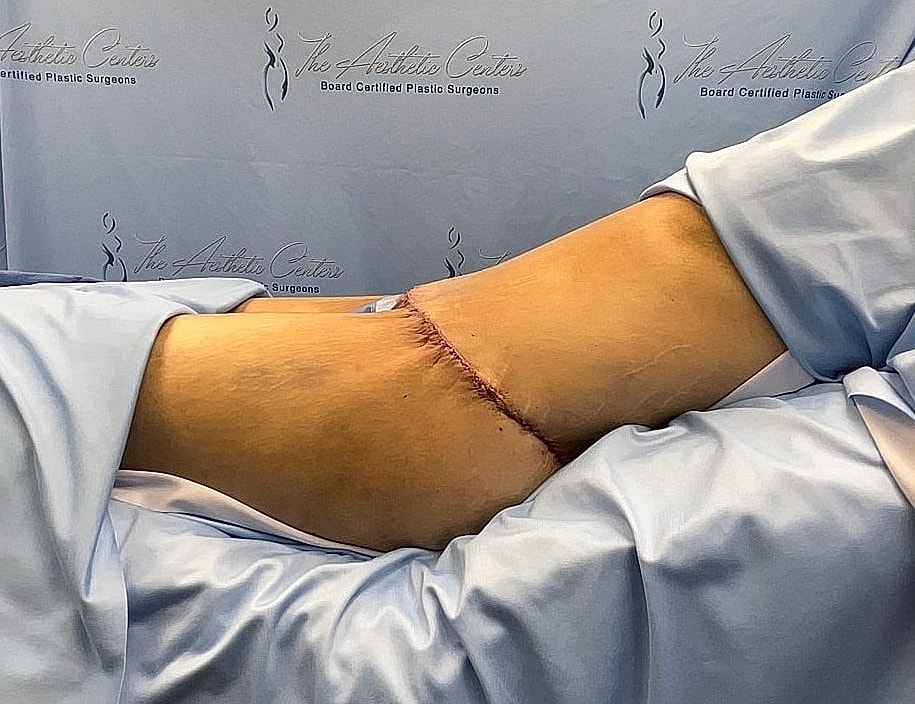 Surgical scar on patient’s arm post-operation.
