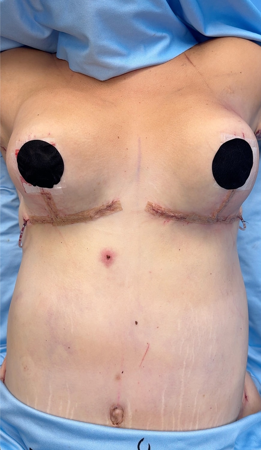 Post-surgical chest with bandages and markings.