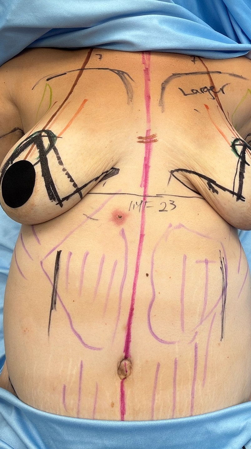 Body markings for cosmetic procedure preparation.