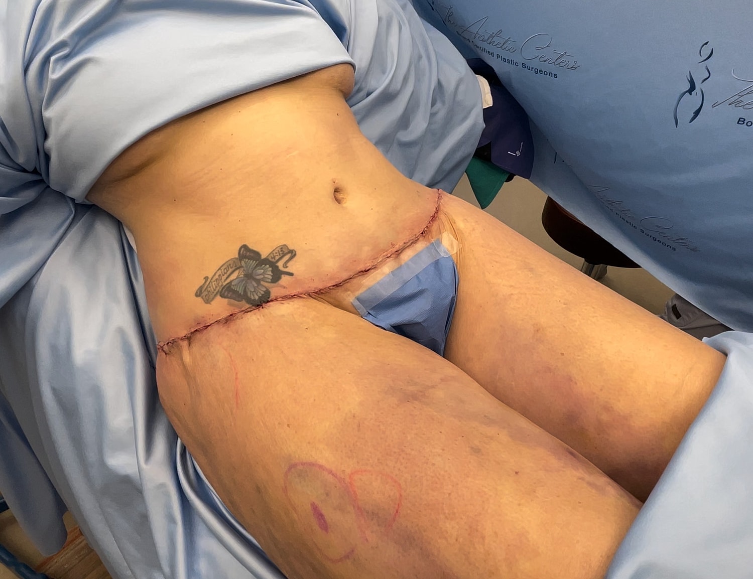 Surgical incision with tattoo in recovery room.