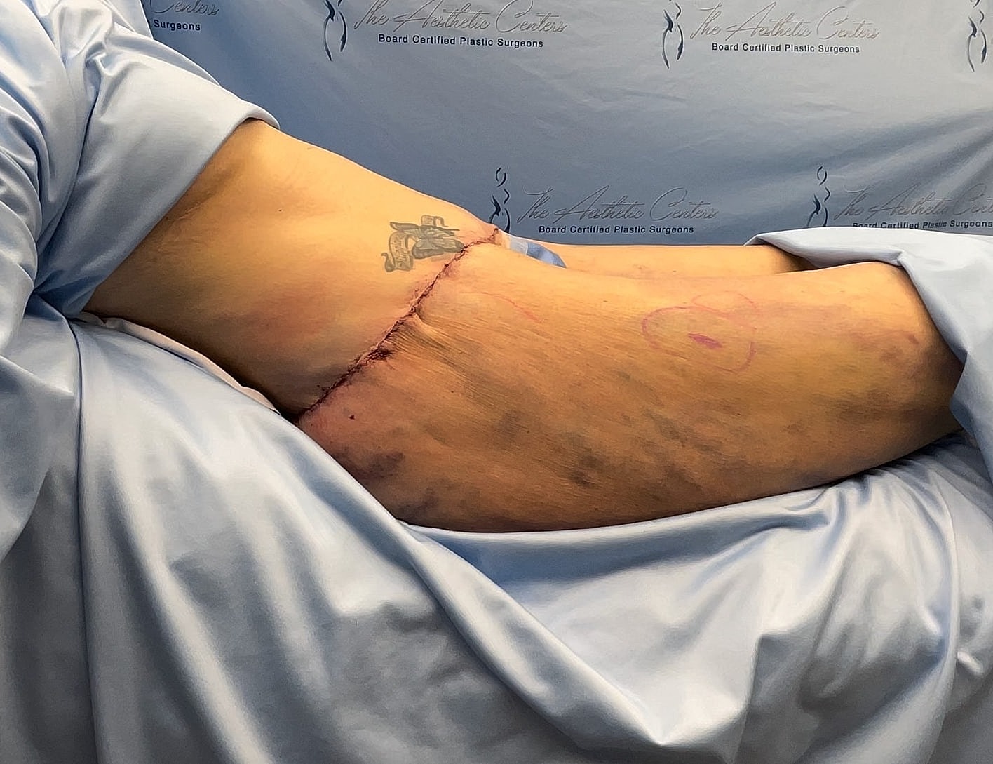 Surgical incision on a patient's arm.